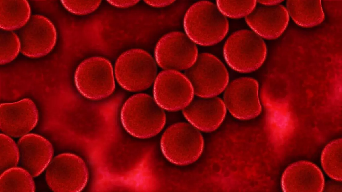 Thiếu máu là tình trạng máu ngoại vi có ít huyết sắc tố và hồng cầu