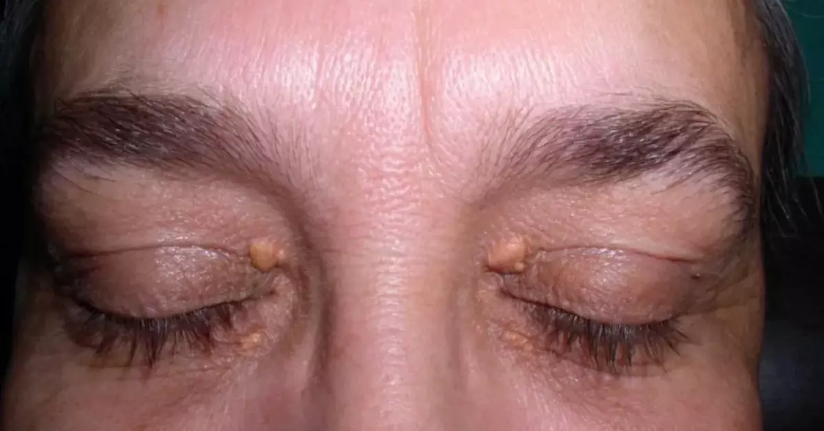 Ban vàng mi mắt là một trong các triệu chứng của mỡ máu cao