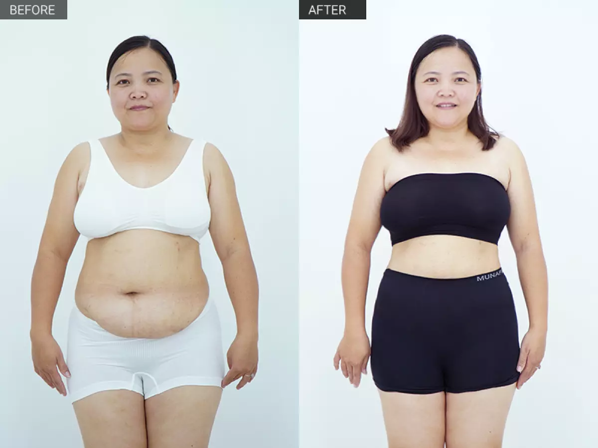 Trước và sau khi giảm mỡ bụng